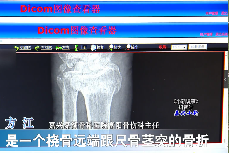 97歲高齡老人，傳統(tǒng)復(fù)位免于手術(shù)3.png